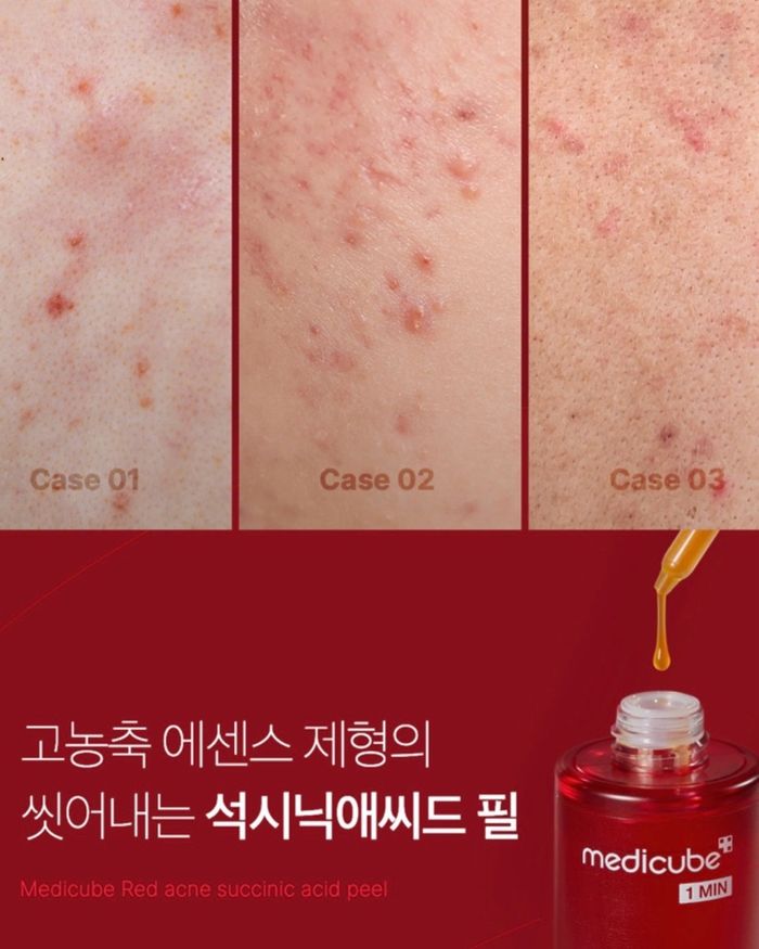   RED ACNE SUCCINIC ACID PEEL