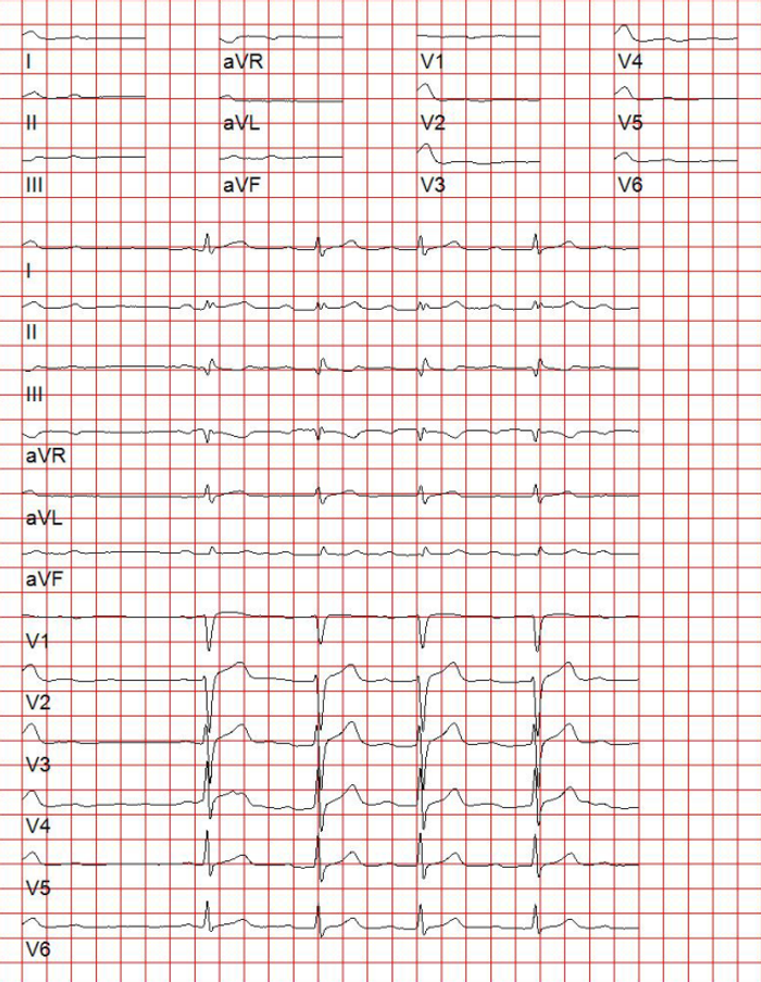 ECG 19