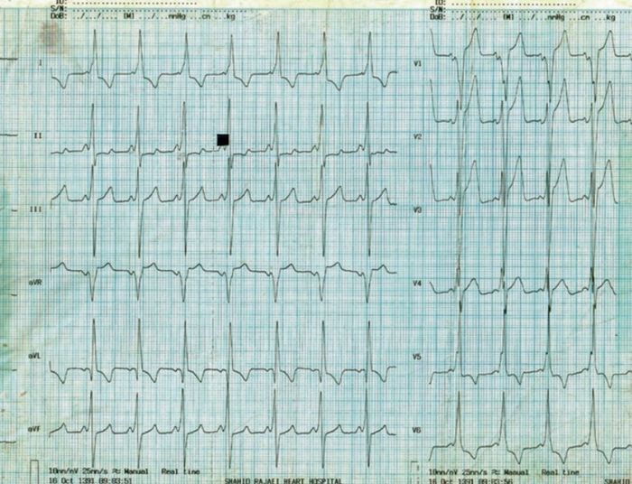 ECG 3