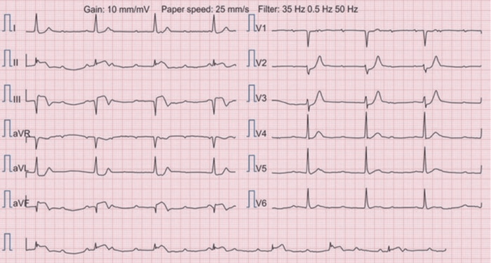 ECG 1