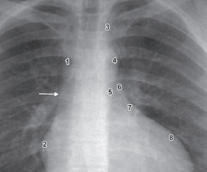 X-ray 2