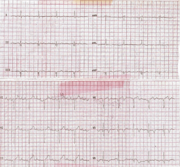 ECG 2