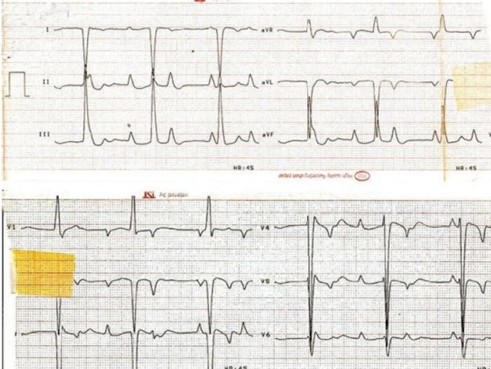 ECG 14
