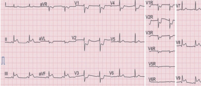 ECG 7